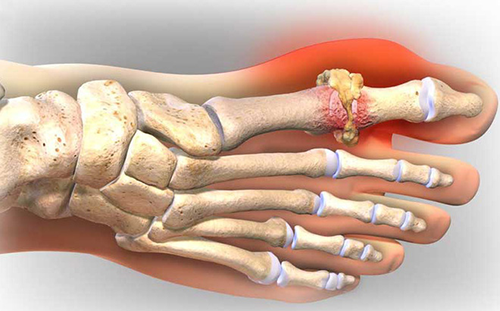 Nguyên nhân bệnh gout làm suy giảm chức năng sinh lý ở nam giới