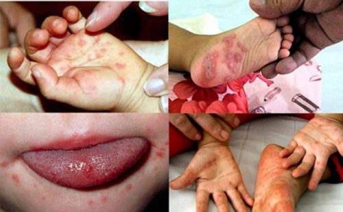 Chân tay miệng bệnh gây nhiều biến chứng ở trẻ nhỏ