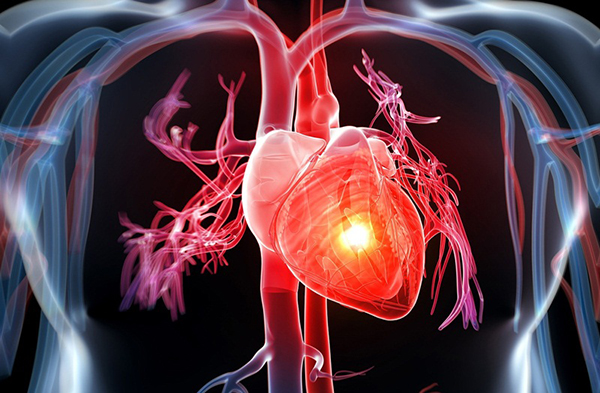 Bệnh tim mạch là một tập hợp các bệnh lý ảnh hưởng đến tim và mạch máu